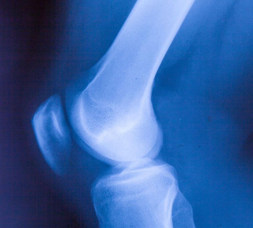 Obraz RTG przedstawiający staw kolanowy w ujęciu bocznym, widoczna kość udowa, piszczelowa oraz rzepka.