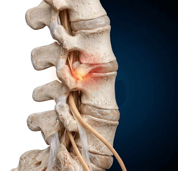 Zbliżenie na anatomiczny model ludzkiego kręgosłupa, przedstawiający zaawansowaną dyskopatię – wypadnięcie jądra miażdżystego z krążka międzykręgowego, widoczne jako czerwona, bolesna zmiana uciskająca nerwy rdzeniowe.