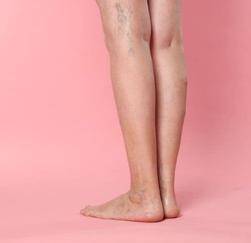 Zbliżenie na nogi i stopy kobiety z widocznymi pajączkami i żylakami na różowym tle – widok od tyłu.